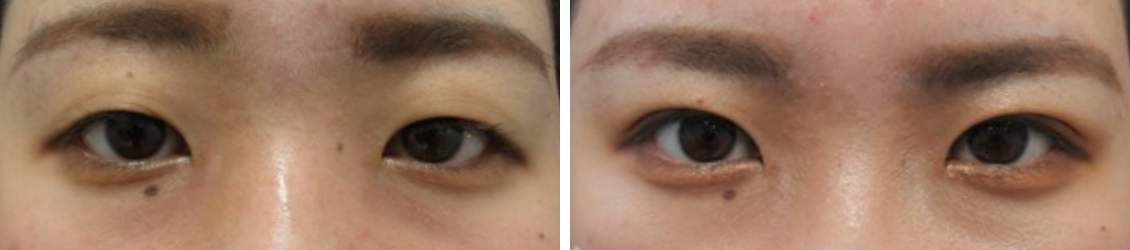 1dayナチュラルデザインオプティマルならここまで自然！