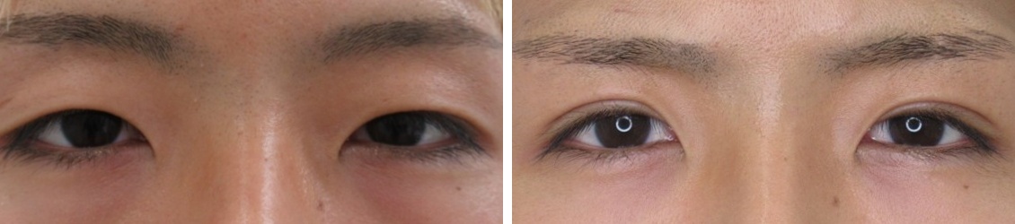 埋没法でナチュラルな二重へ