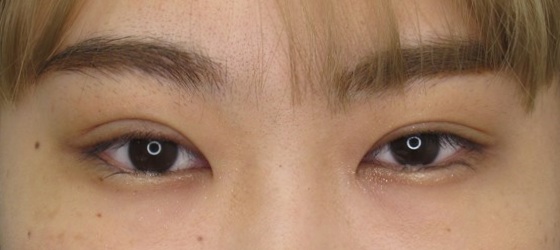 症例写真 ダウンタイム 一重まぶたから魅力的なアーモンドアイへ Taクリニック 美容整形 美容外科 新宿 銀座 横浜 大阪 福岡 川越 高崎 Taクリニック 美容整形 美容外科