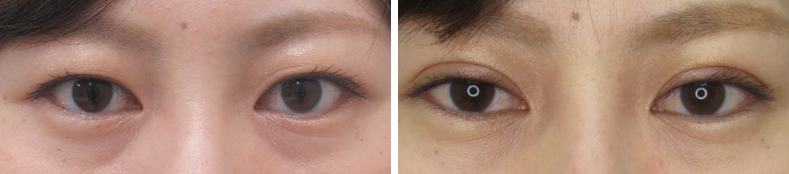 二重埋没法の症例写真 施術前後 1か月後