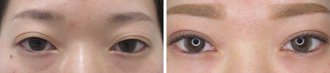 埋没法で美人な目元へ