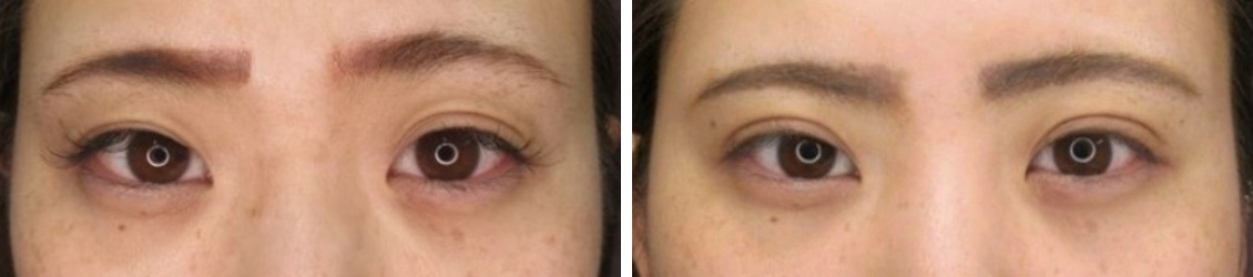 左右差のあるお目元を埋没法で改善