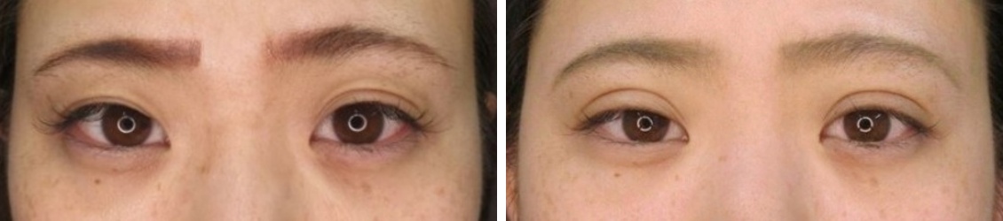 二重埋没法の症例写真 施術前後 １週間後