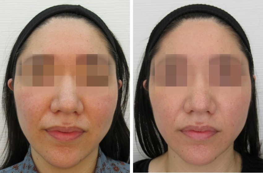 メーラーファット除去でスッキリフェイス