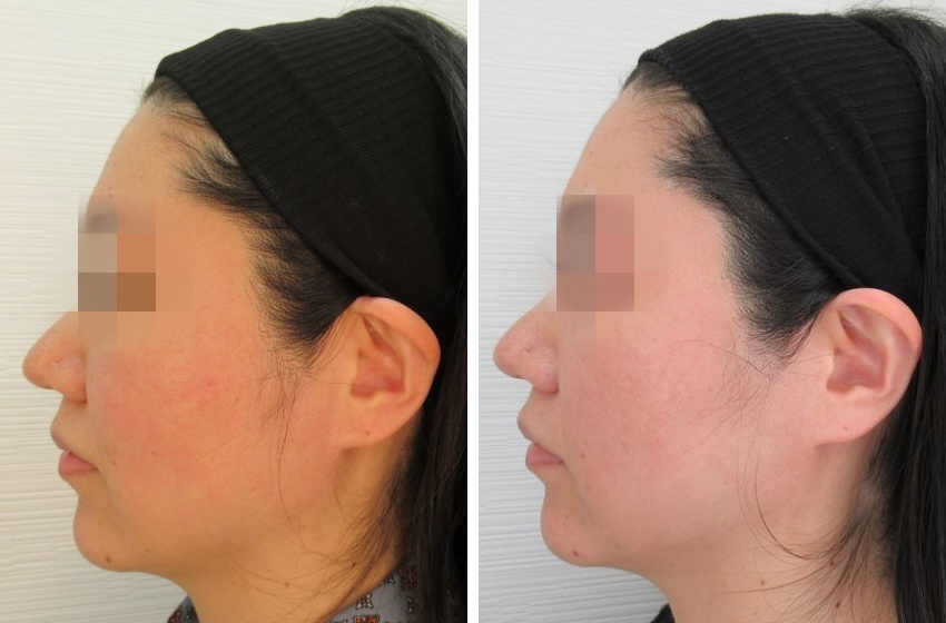 メーラーファット除去/ジョールファット除去の症例写真 施術前後 1ヵ月後