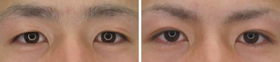 埋没法でナチュラルな末広型二重を実現