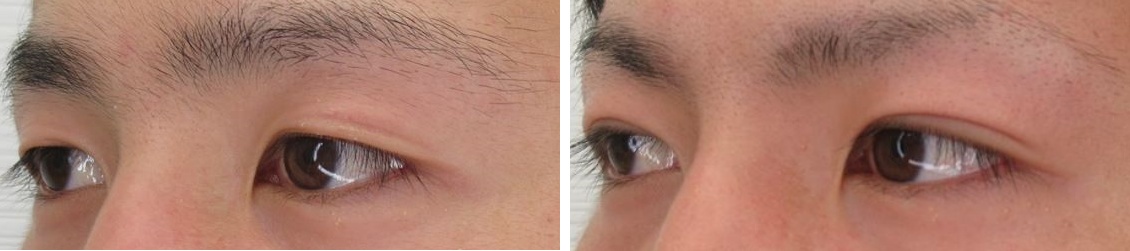 二重埋没法の症例写真 施術前後 1ヵ月後