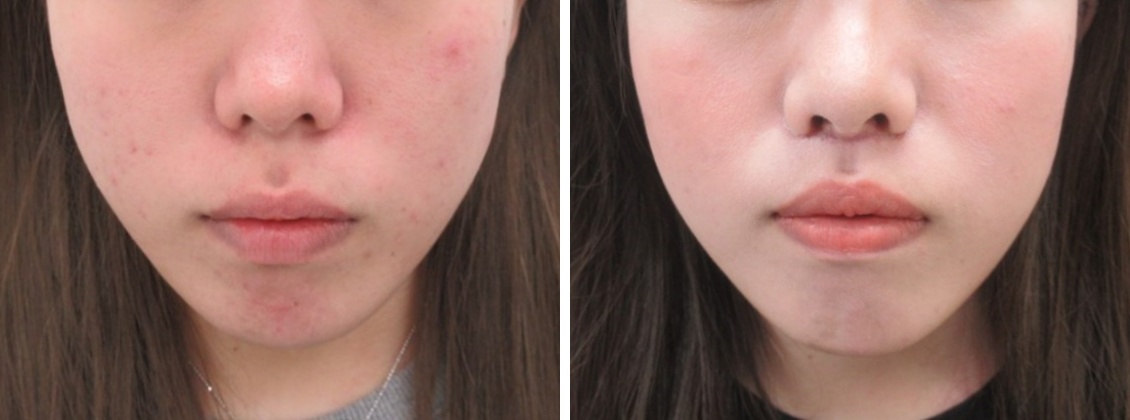 人中短縮術(リップリフト)・外側人中短縮術の症例写真 施術前後 1ヵ月