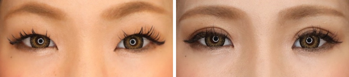 埋没法ですぐにかわいい目元に