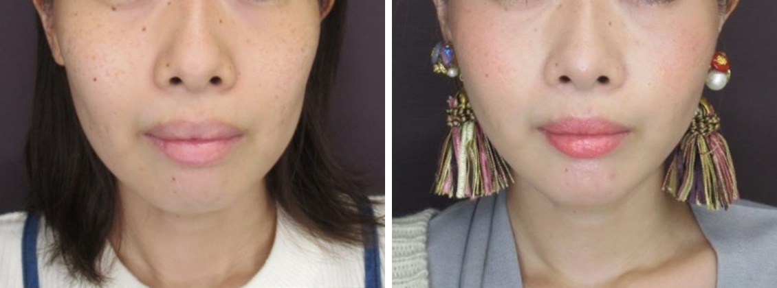 キツネVラインフェイスでアンチエイジング