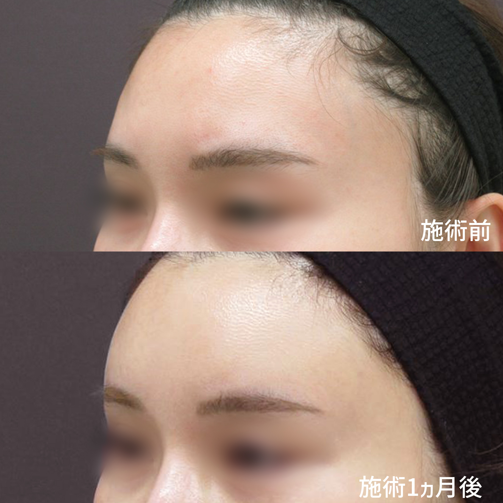 顔の脂肪注入(コンデンスリッチフェイス)の症例写真 施術前後 1ヵ月