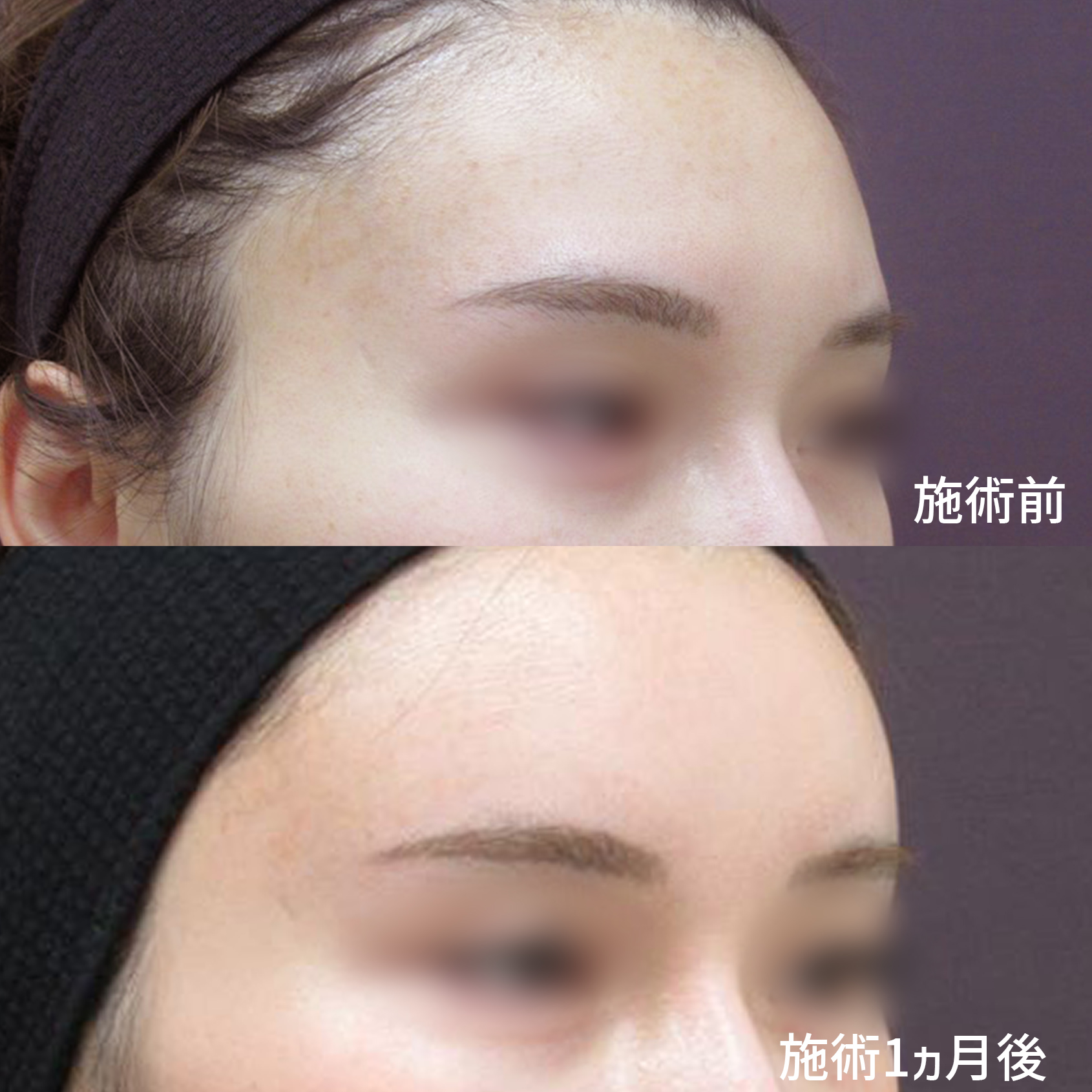 顔の脂肪注入(コンデンスリッチフェイス)の症例写真 施術前後 1ヵ月