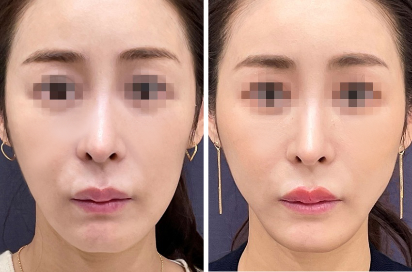 TAC式 ツヤ肌コラーゲンリフト®/ジョールファット除去の症例写真 施術前後 1ヵ月後