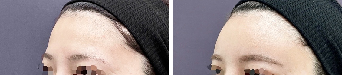 コンデンスリッチフェイスで少しの凹みまで治せます