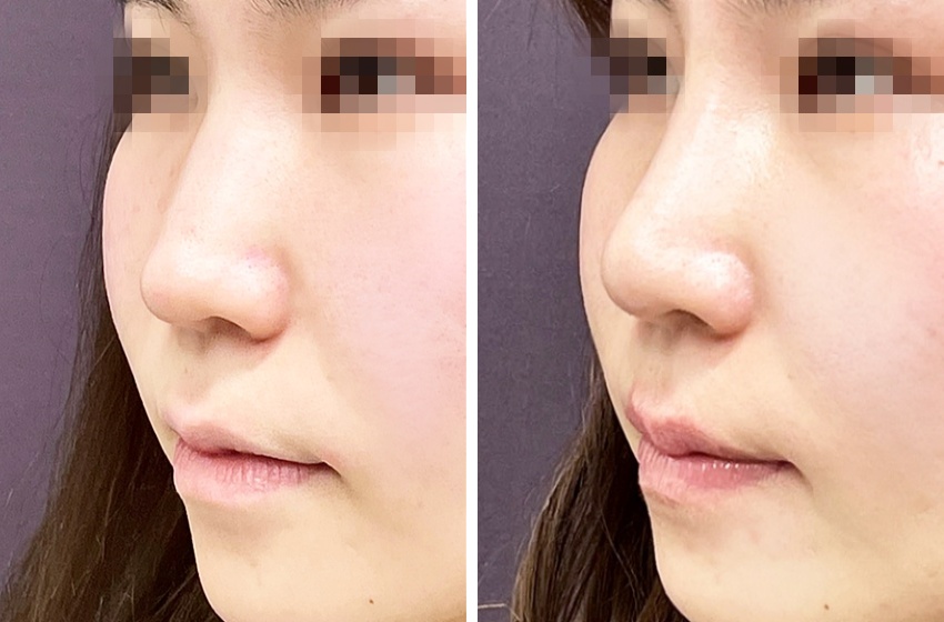 隆鼻術プロテーゼ・４Dノーズ・鼻尖縮小術で自然な美鼻