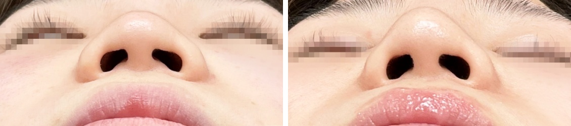 隆鼻術（プロテーゼ・自家組織）/鼻尖4Dノーズ/鼻尖形成・鼻尖縮小の症例写真 施術前後 1ヵ月