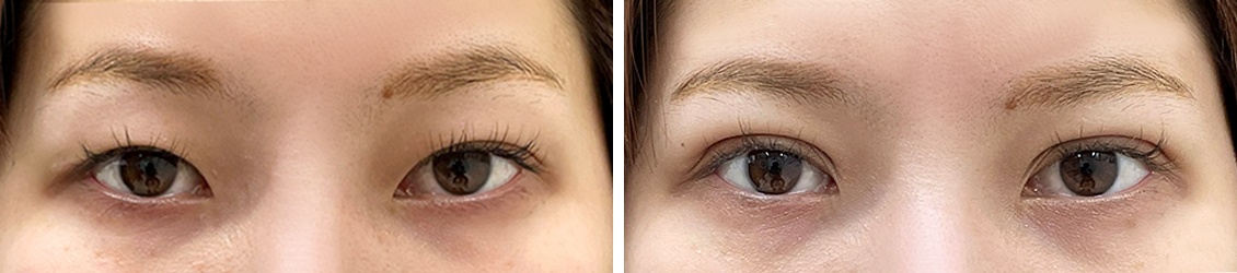 埋没法でナチュラルかわいい目元