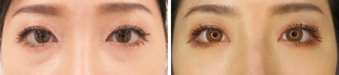 下眼瞼脱脂術(目の下のふくらみ取り・クマ改善)で明るく元気な印象に