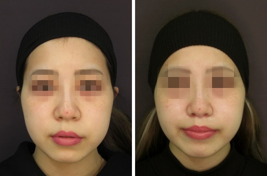 人中短縮術と口角リフトで間延びしたお顔を垢抜けフェイスに