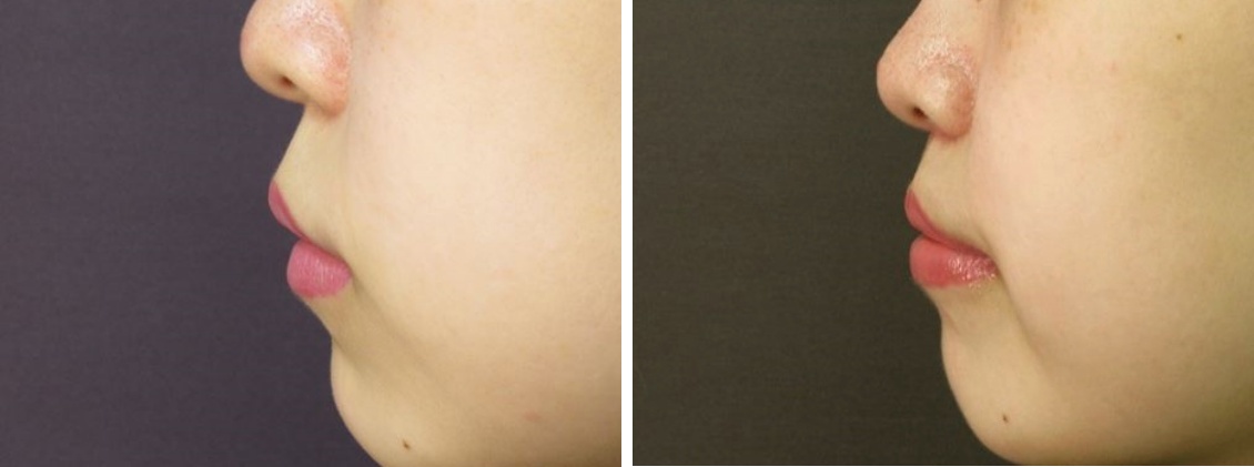 人中短縮術(リップリフト)・外側人中短縮術/口角挙上・リフト（マイクロ切開法・内側法/口内法）の症例写真 施術前後 1ヵ月