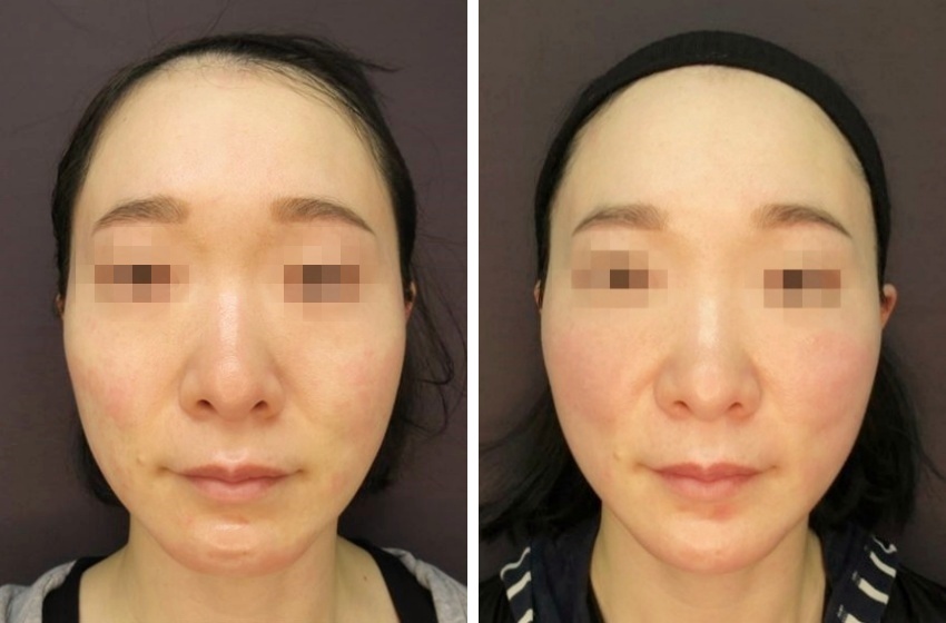 ツヤ肌コラーゲンリフト、メーラーファット除去で自然な若返り