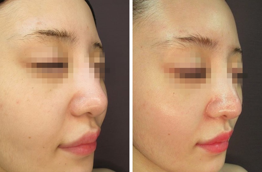 鼻尖縮小と鼻尖4Dノーズで鼻先美人に