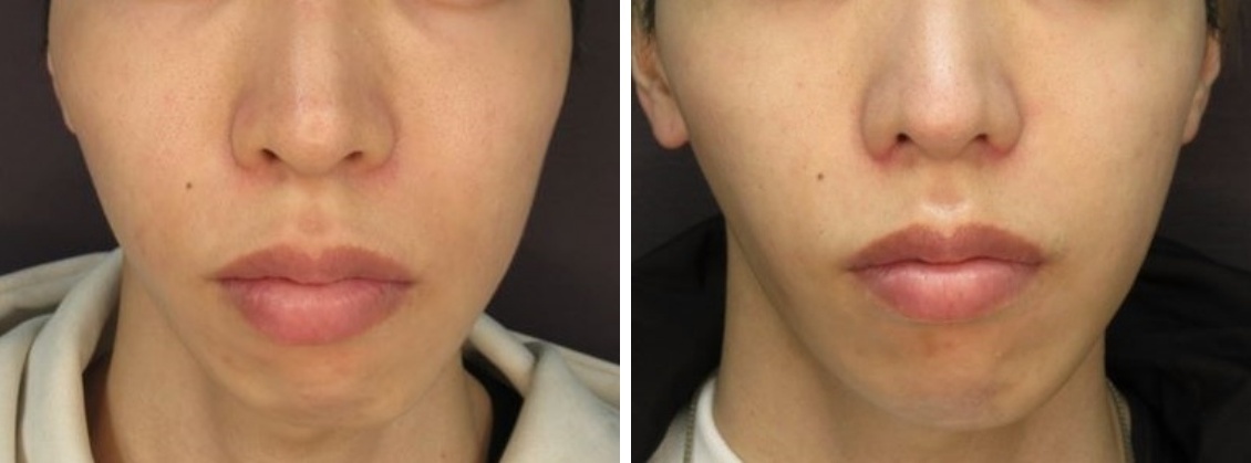 鼻尖縮小術、鼻尖4Dノーズ、鼻翼縮小術、ヒアルロン酸アゴで整った綺麗なお顔立ちに