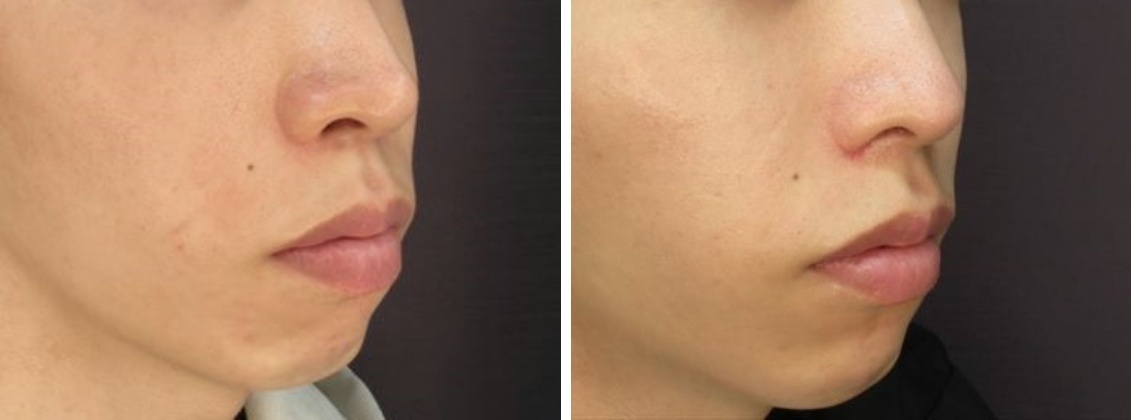 TAC式 鼻翼縮小術（小鼻縮小）/鼻尖形成・鼻尖縮小/鼻尖4Dノーズの症例写真 施術前後 １ヵ月後