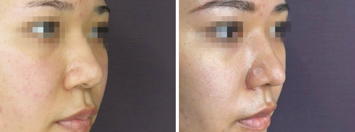TAC式 鼻翼縮小術（小鼻縮小）/鼻尖形成・鼻尖縮小/鼻尖4Dノーズの症例写真 施術前後 1ヵ月後