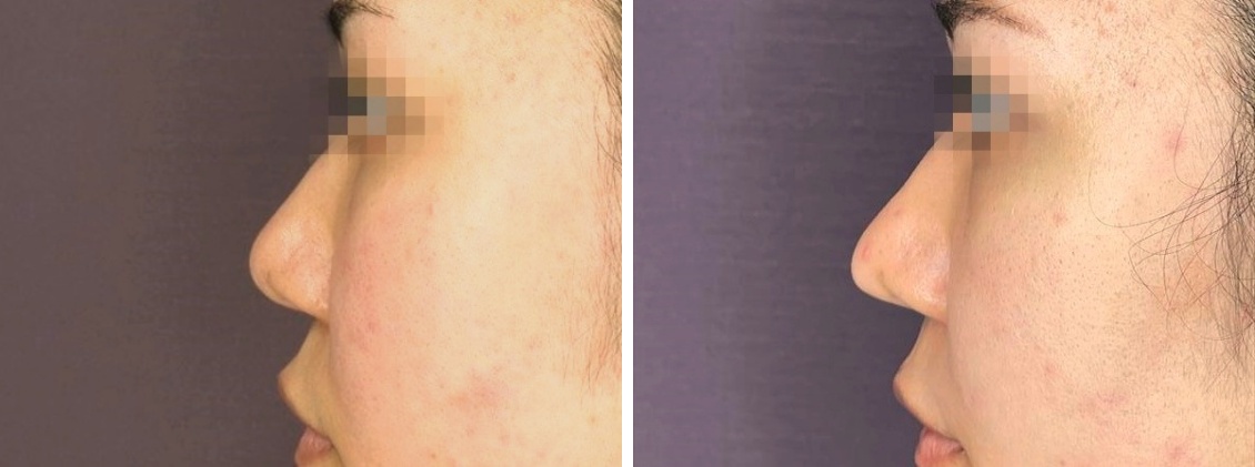 TAC式 鼻翼縮小術（小鼻縮小）/鼻尖形成・鼻尖縮小/鼻尖4Dノーズの症例写真 施術前後 1ヵ月後