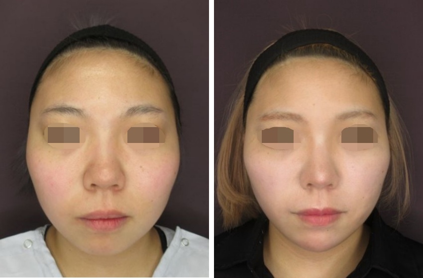 ツヤ肌コラーゲンリフト、バッカルファット除去、メーラーファット除去でスッキリ小顔に。