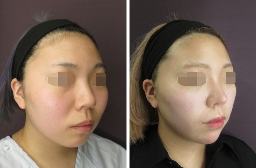 TAC式 ツヤ肌コラーゲンリフト®/エラボトックス注射/バッカルファット除去の症例写真 施術前後 1ヵ月