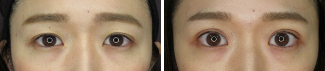 二重埋没法でマスク映えする目元美人へ