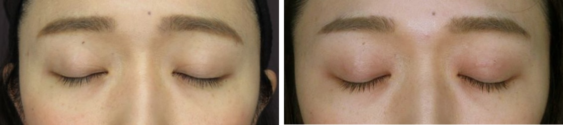 二重埋没法の症例写真 施術前後 1ヵ月後