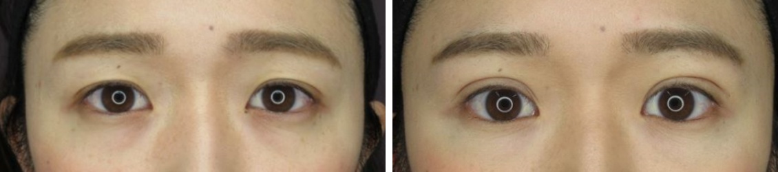 二重埋没法の症例写真 施術前後 1週間後