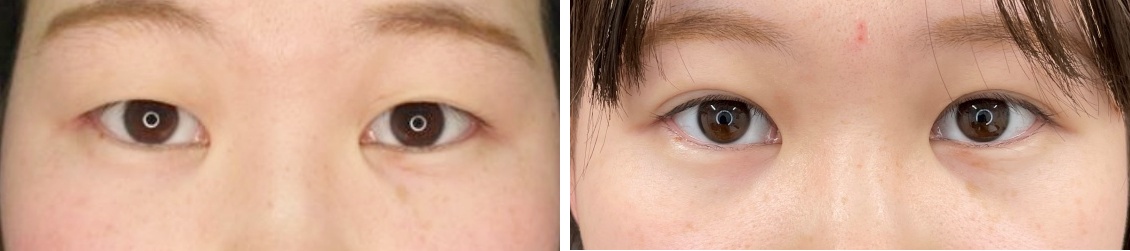 1dayナチュラルデザインオプティマルとマイクロカットの組み合わせで目力アップ。