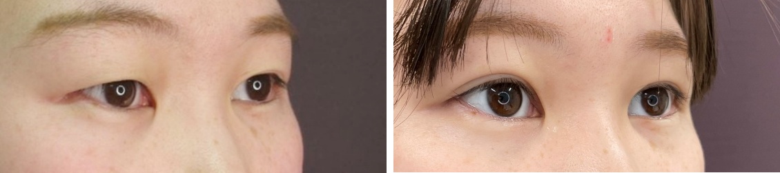 二重埋没法の症例写真 施術前後 1ヵ月後