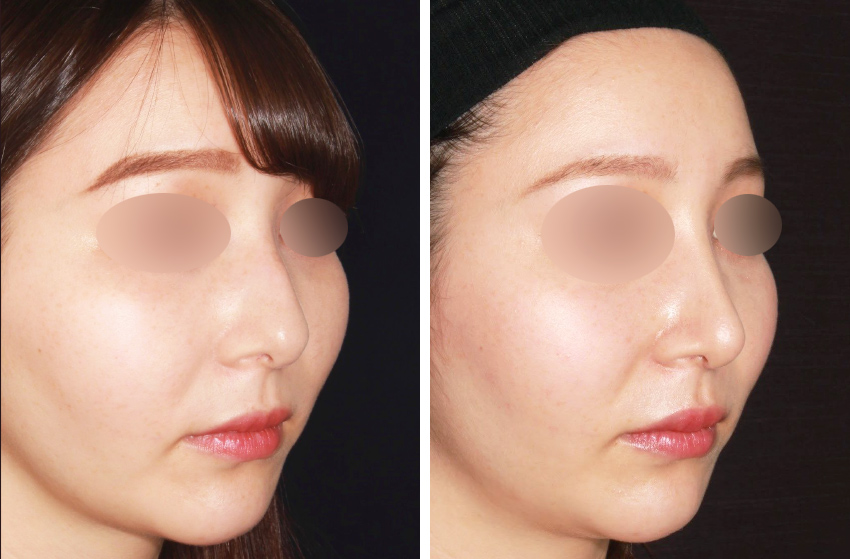鼻先軟骨移植/鼻：その他の症例写真 施術前後 4ヵ月