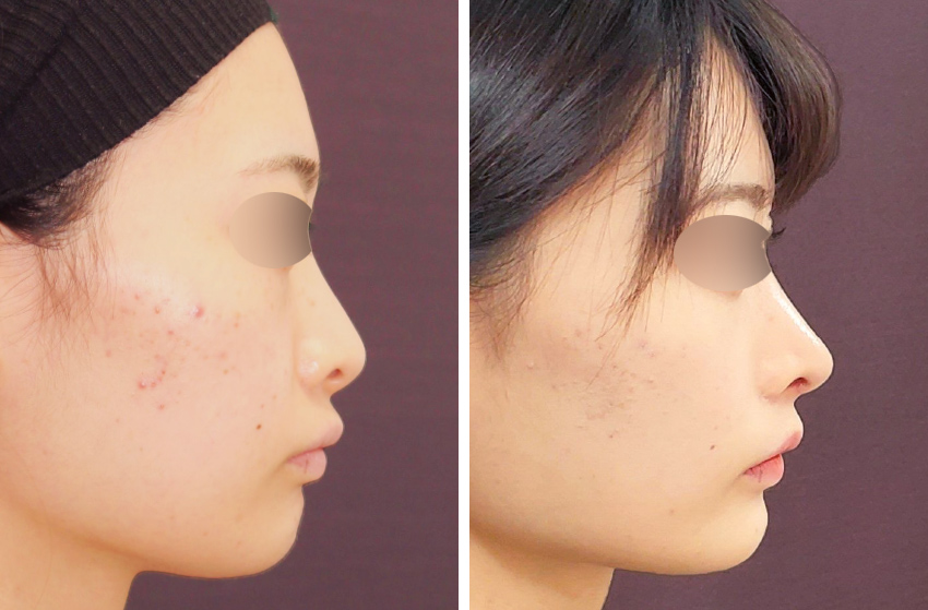 症例写真 ダウンタイム 他院修正でだんご鼻と小鼻の広がりを解消 Taクリニックグループ 美容整形 美容外科 全国展開中