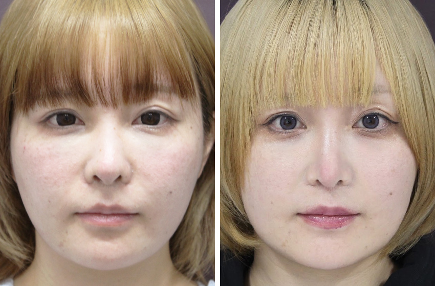 鼻尖形成・鼻尖縮小/鼻中隔延長術/鼻：その他の症例写真 施術前後 3ヵ月