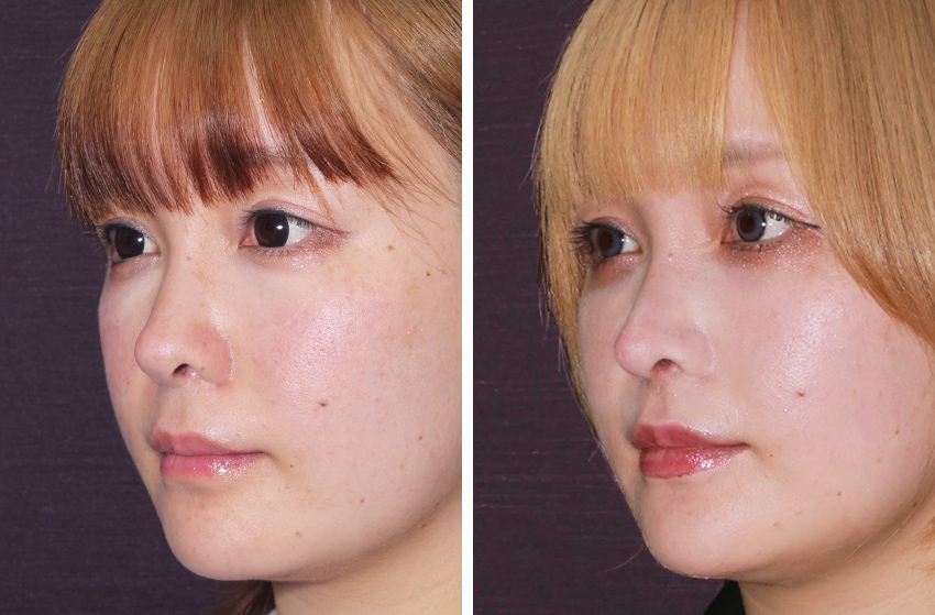 鼻尖形成・鼻尖縮小/鼻中隔延長術/鼻：その他の症例写真 施術前後 3ヵ月