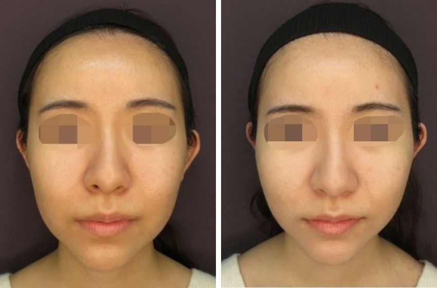 メーラーファット除去、ジョールファット除去で余分な脂肪をとり、エラ　ボツリヌストキシンで筋肉の張りを軽減、さらにTAC式ツヤ肌コラーゲンリフトできれいなフェイスラインへ