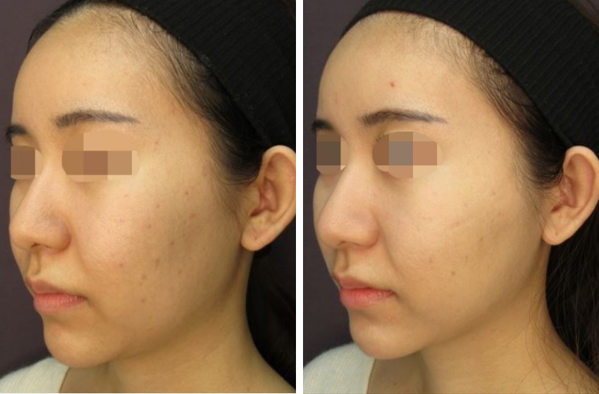 TAC式 ツヤ肌コラーゲンリフト®/エラボトックス注射/ジョールファット除去の症例写真 施術前後 １ヵ月後