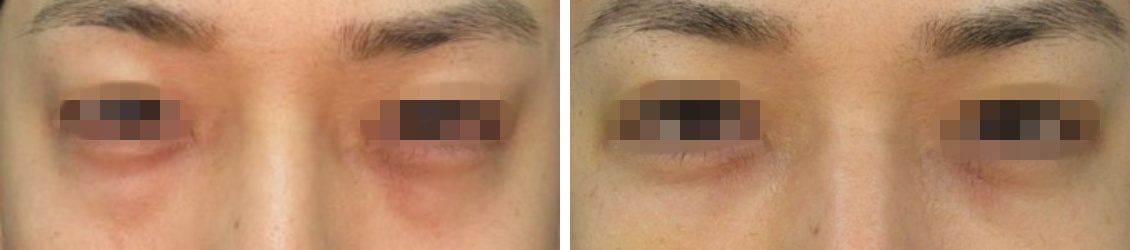 下眼瞼脱脂術で若々しく。