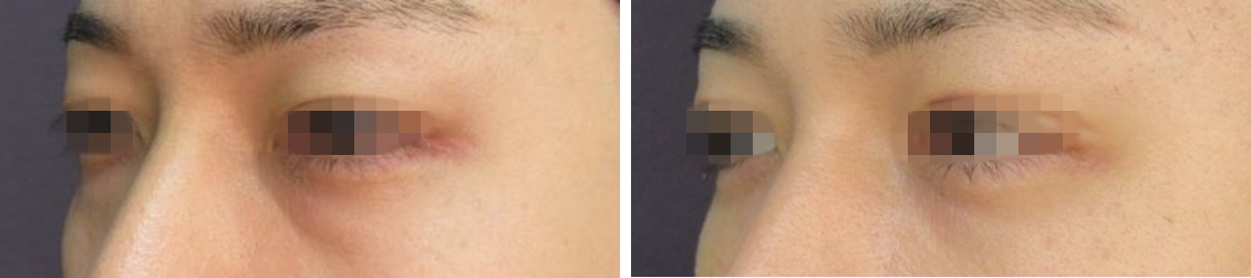 下眼瞼脱脂術（目の下のたるみ取り・目の下の脂肪ふくらみ取り）の症例写真 施術前後 １ヵ月後