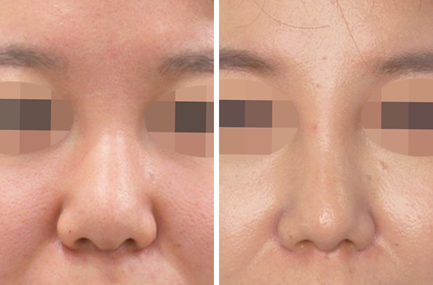 プロテーゼと軟骨移植でシュッとした鼻へ