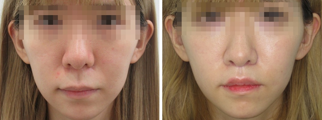 人中短縮術で可愛くなりました！