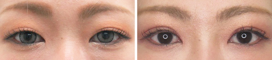 埋没法で憧れのくっきり二重へ