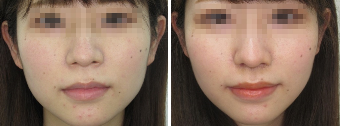 人中短縮術でバランスの整ったお顔へ