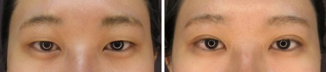 ナチュラルに映えるTAC式二重術